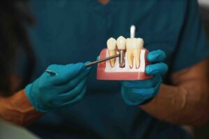 quanto dura un impianto dentale