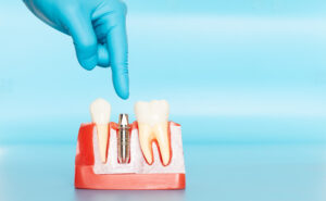 Plastic samples of dental implants compare with natural teeth