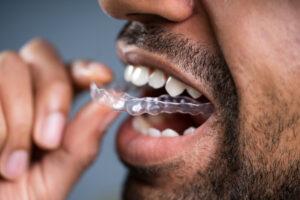 Man Putting Transparent Aligner In Teeth