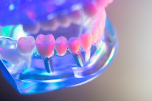 Dental healthy teeth implants