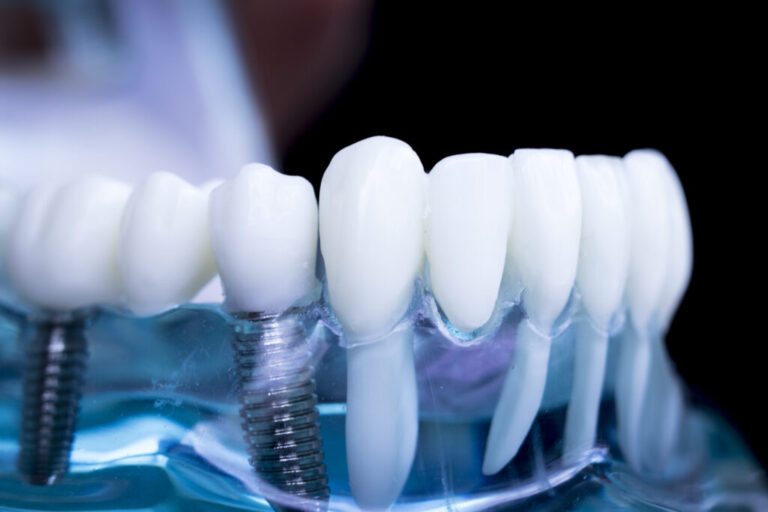 Dentist dental teeth implant