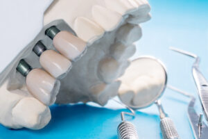 Close up implant and prosthodontic model