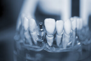 Transparent Model of Human Teeth with implants close-up